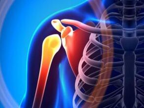 Воспаление плечевого сустава вследствие артроза – хронического заболевания опорно-двигательного аппарата. 